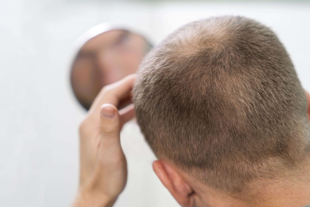 Hair Transplant Prices 2023 - Apex Clinic Hair Transplant Prices 2023 - Apex Clinic