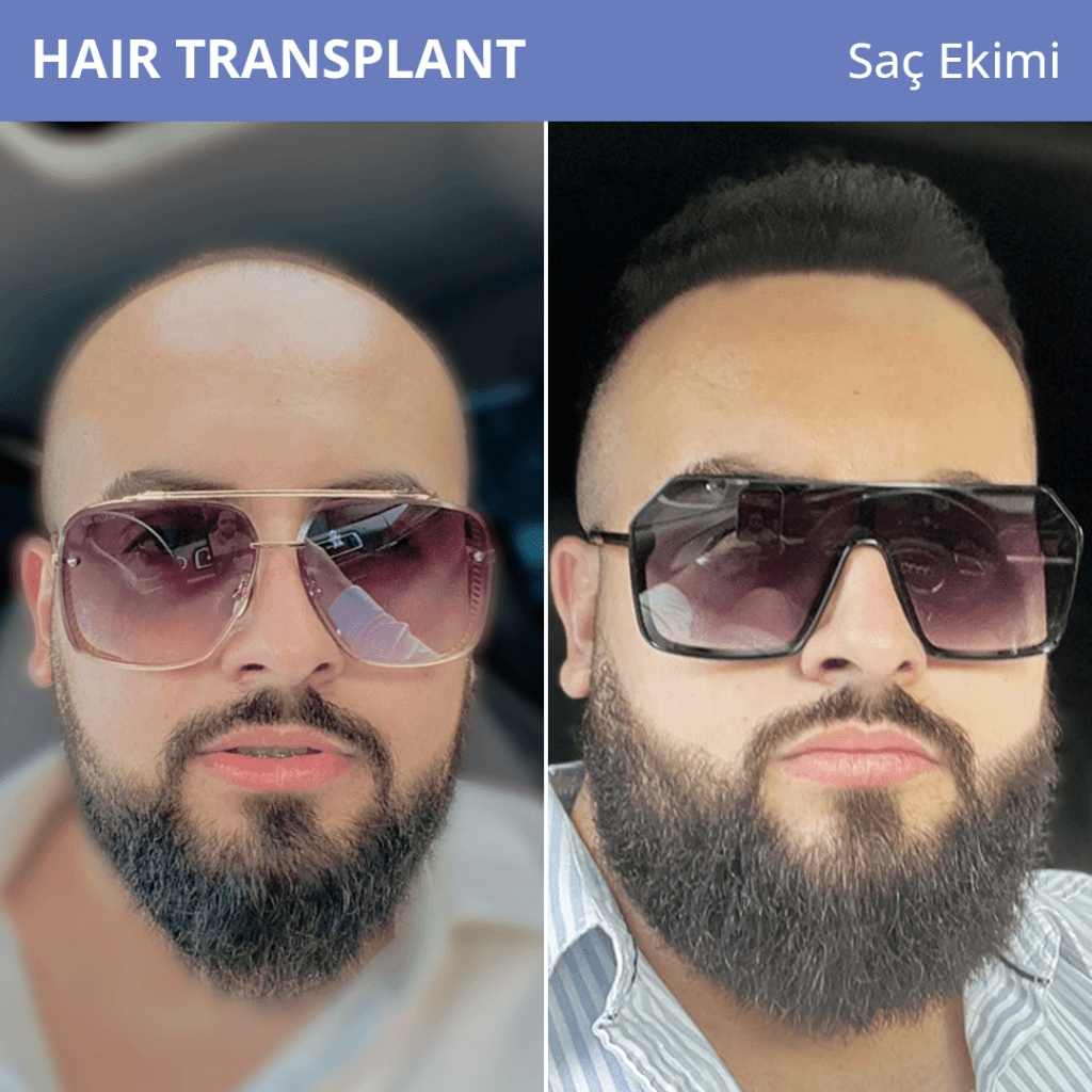 Hair Transplantation Apex Clinic